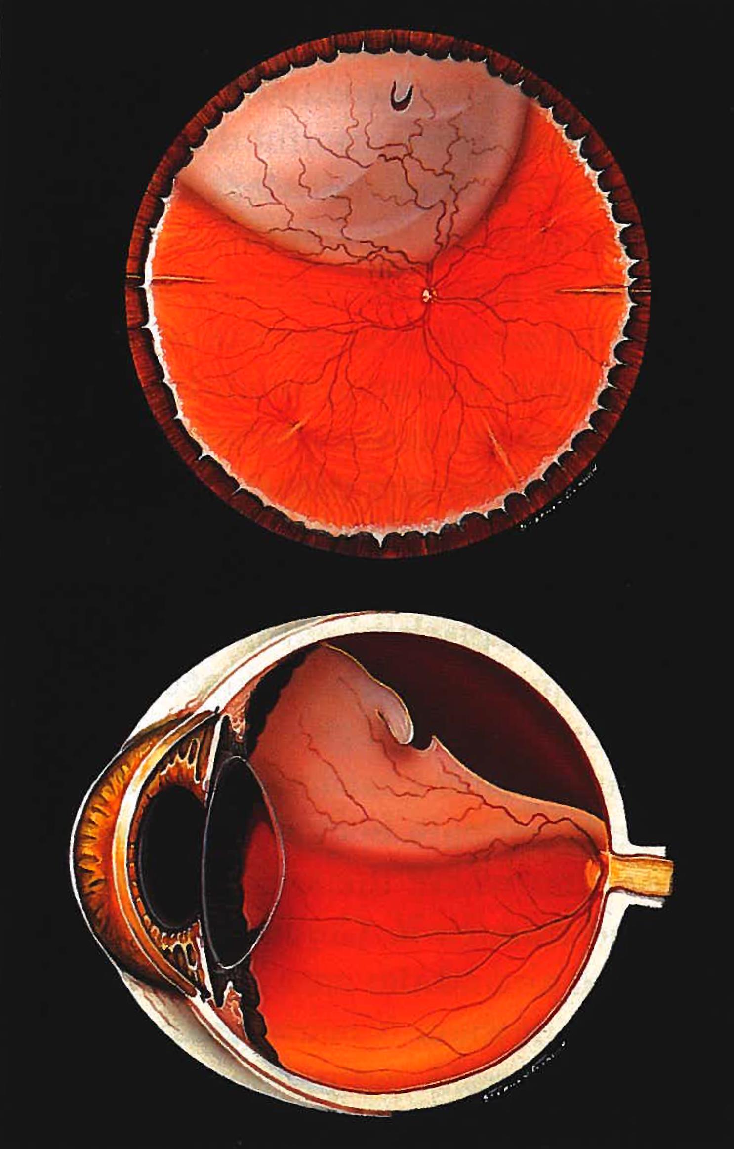 torn retina vision