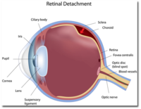 anesthesia for retina detachment surgery elderly