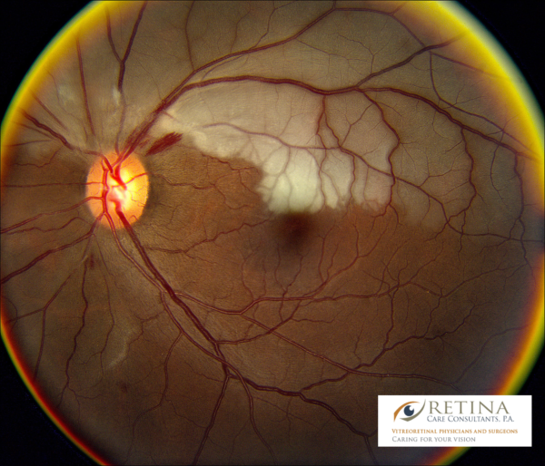 Retinal Artery Occlusion Diagnosis | Eye Stroke Improvement