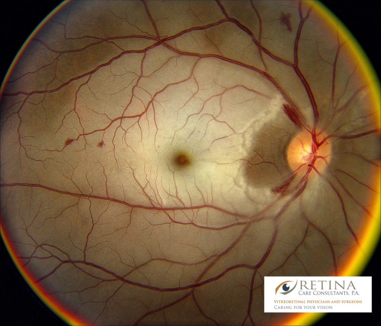 Retinal Artery Occlusion Diagnosis Eye Stroke Improvement