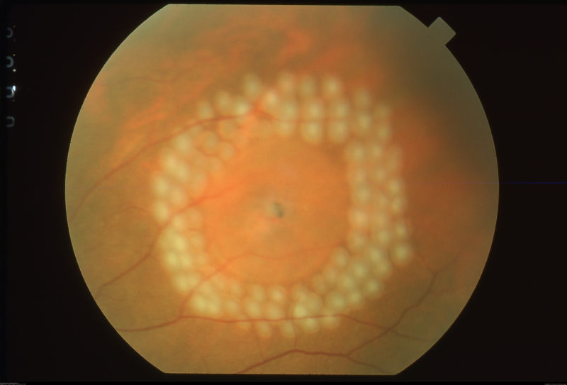 retina tear surgery